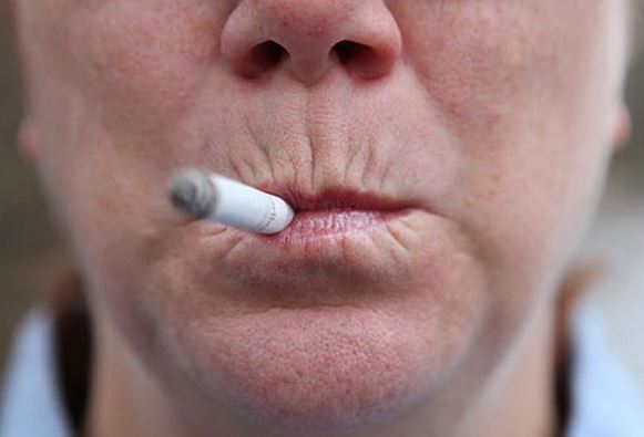 Smoker’s Lines： How To Get Rid Of It？